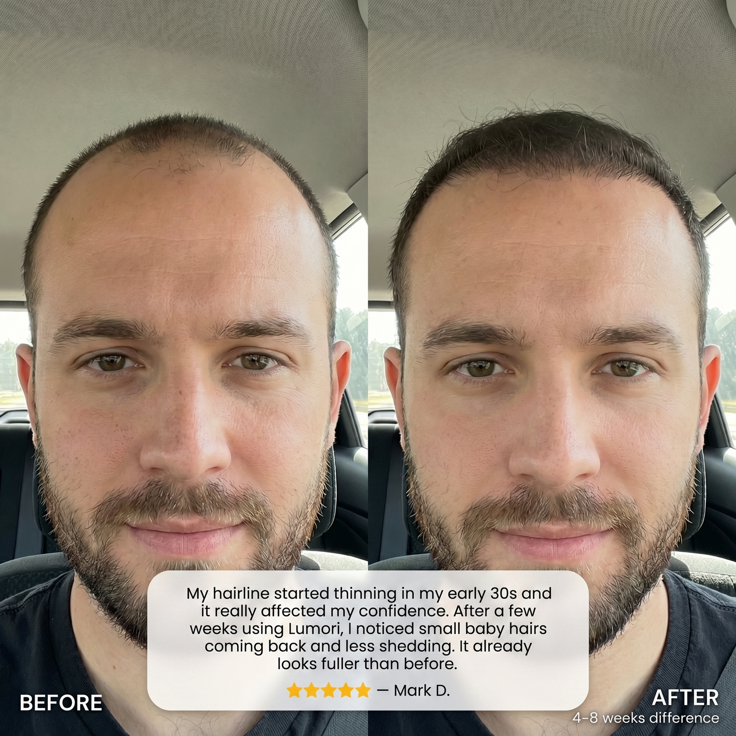 Lumori™ Hair Regrowth Treatment
