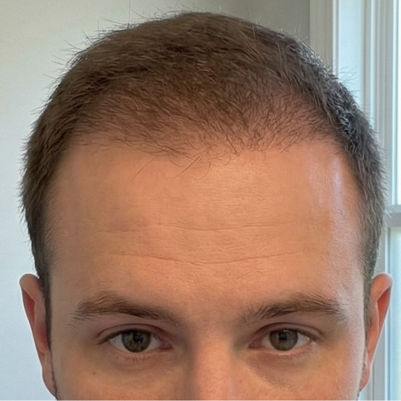 Less Shedding. Early Changes